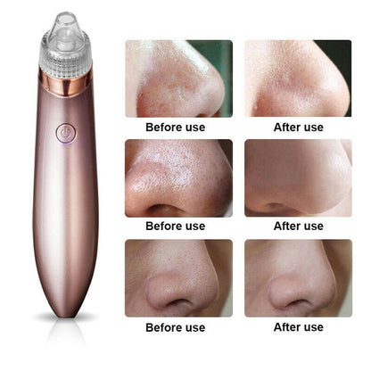 Electric Blackhead Vacuum Remover - Treasure Mementos